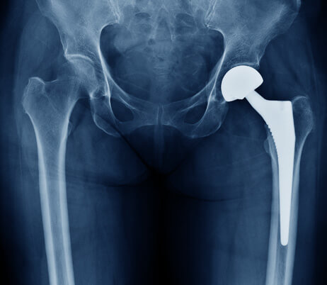 The Joint Replacement Institute - Patient-Specific Implants