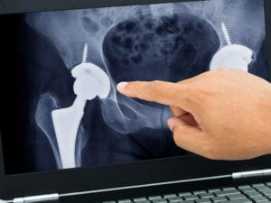 joint replacement - knee replacement surgery - hip replacement surgery