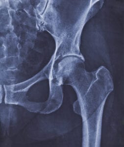 Hip Surgeries