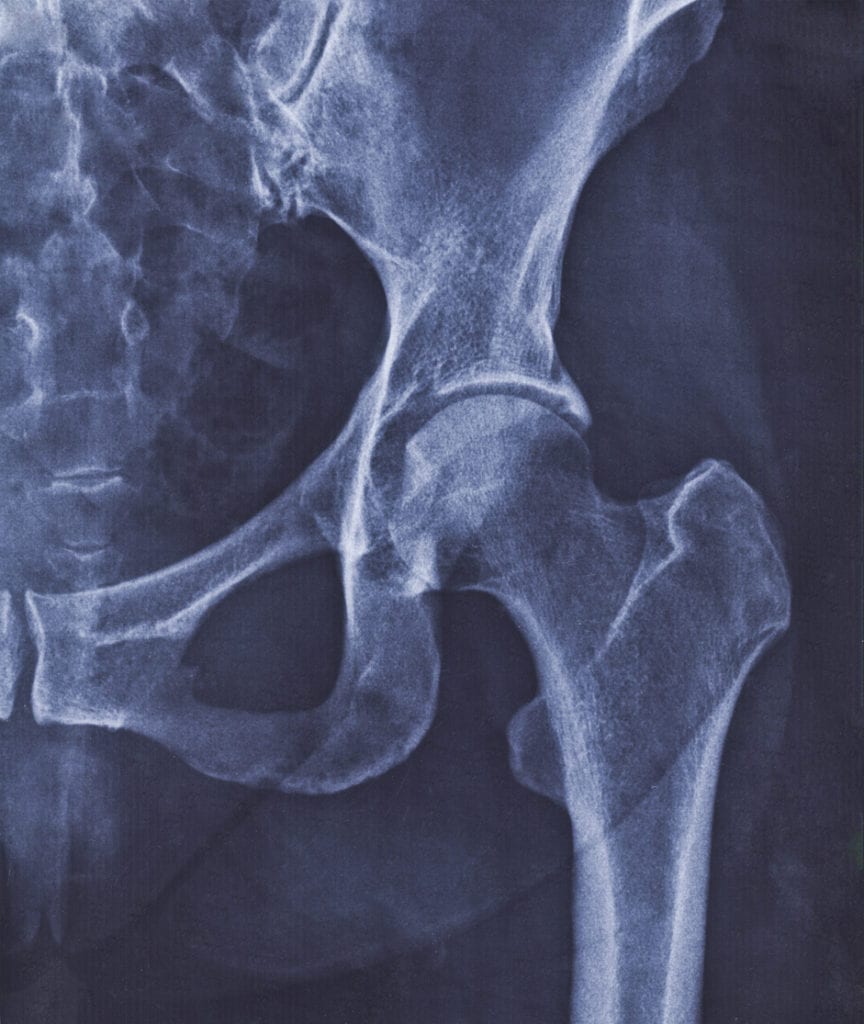 Hip Surgeries