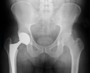 Total Joint Replacement Surgery