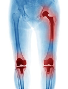 Knee Replacement Surgery