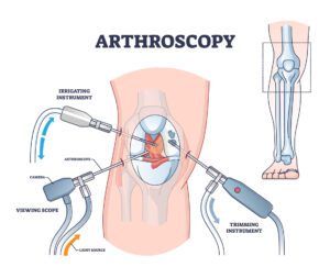 Arthroscopy procedure outline Diagram