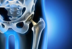 3d rendering of total hip replacement - medical illustration