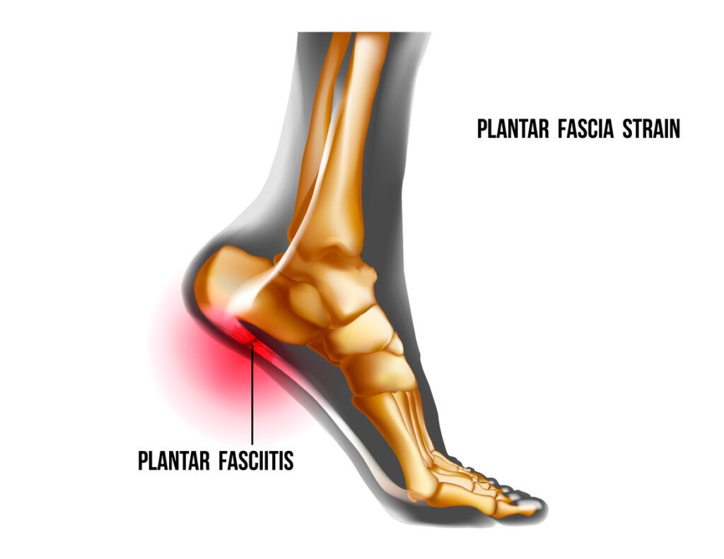 Plantar fasciitis inflammation and ruptures strain