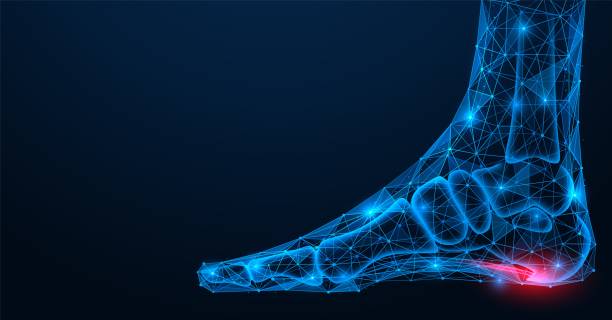 Heel spur, injury to the plantar ligament of the leg. Polygonal design of interconnected lines and points. Blue background.