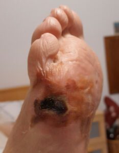 diabetic foot