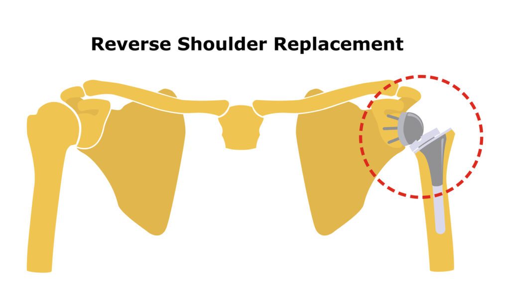 Reverse Shoulder Replacement