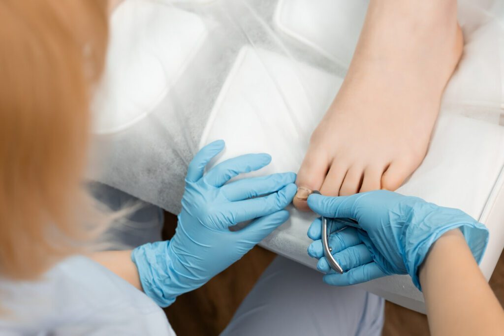 Ingrown Toenails - Joint Replacement Institute - Naples FL