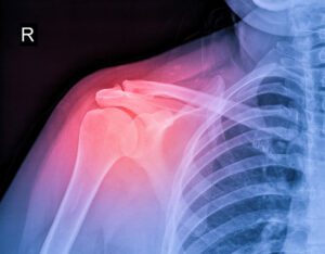 X-ray image of shoulder pain.