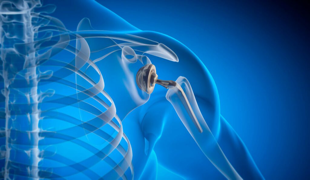 Animated illustration showing an X-ray of a person with a shoulder joint replacement implant.