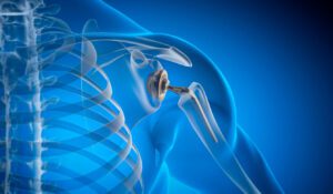 Animated illustration showing an X-ray of a person with a shoulder joint replacement implant.