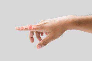 Inflammation of the bone in the forefinger caused by a trigger finger condition.