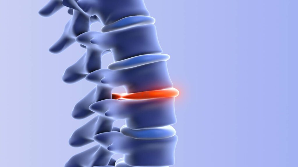 3D Illustration of the human spine with herniated disc.