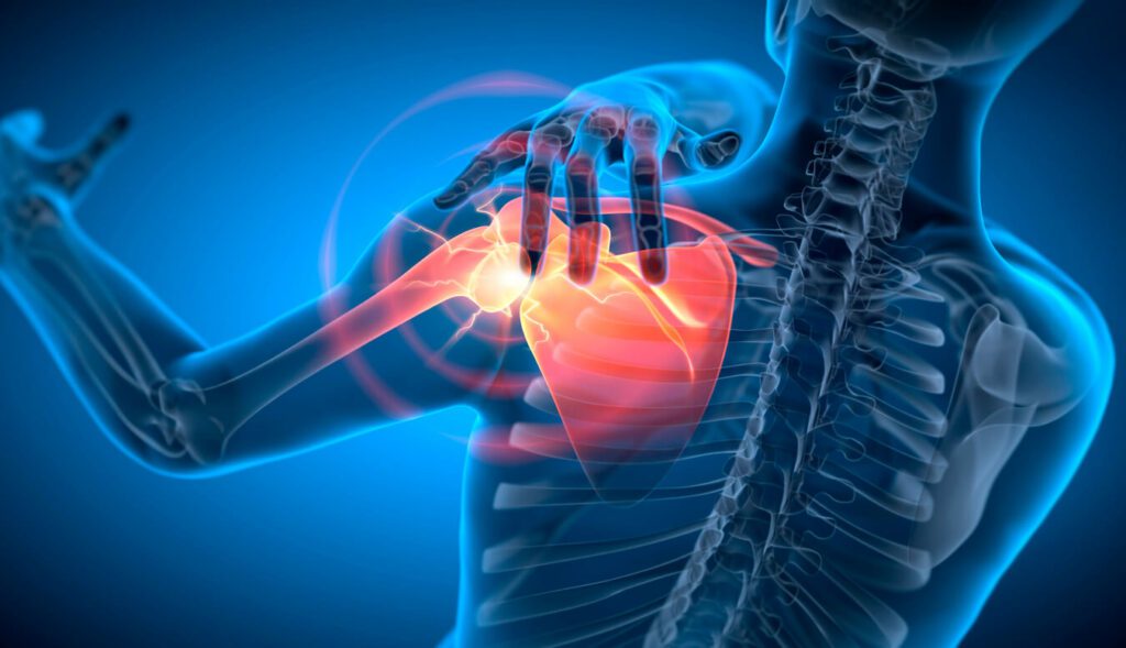 3D X-ray illustration of a man experiencing shoulder pain, depicting the procedure for arthroscopic shoulder surgery.