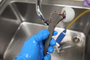 An explanted hip prosthesis is cleaned after hip replacement surgery.