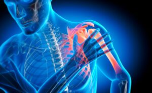 A 3D illustration of a person experiencing pain in the shoulder joint who may require arthroscopic shoulder surgery.